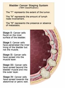 This image outlines the classification and staging system of bladder cancer. As depicted, the stage of bladder cancer is determined based on its invasiveness.