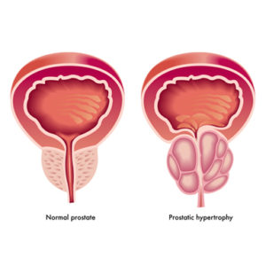 This image shows the difference between normal prostate cells and those that have undergone hypertrophy (enlargement). Prostatic hypertrophy is a typical symptom of prostate cancer.