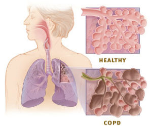 healthy-vs-copd